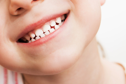 子どものむし歯の原因